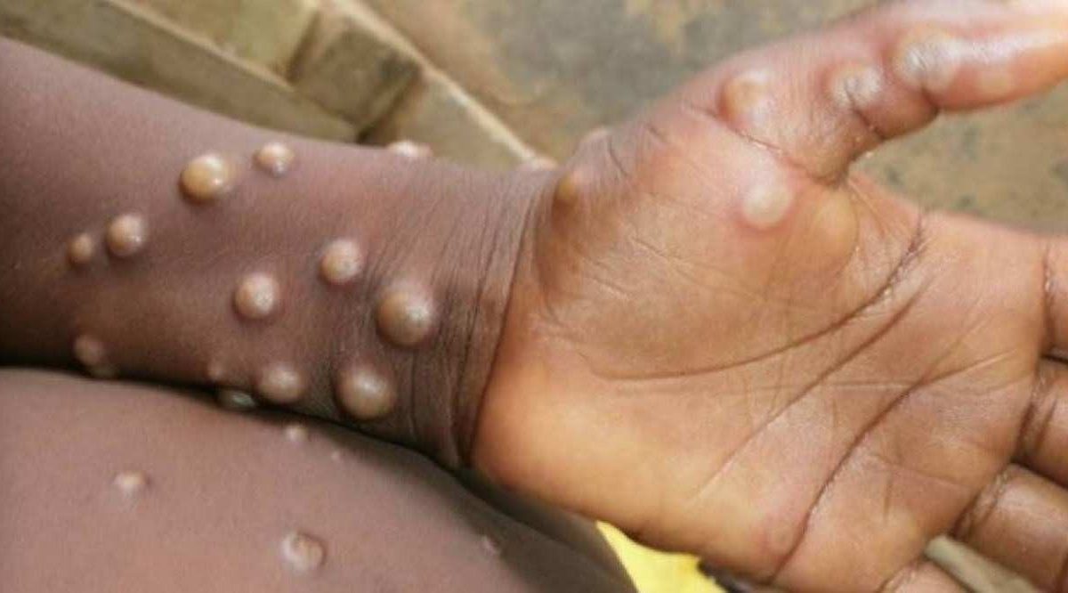 Parnaíba tem três casos suspeitos de varíola dos macacos em investigação
