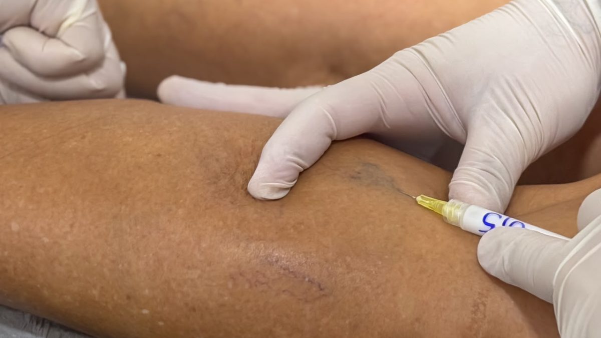 Parnaíba ultrapassa 4 mil procedimentos de varizes em mutirões de saúde